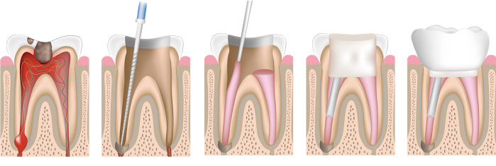 dentes